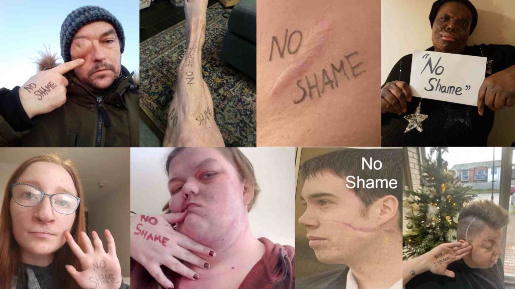 Collage of campaigner pictures each with no shame written next to scars and visible differences