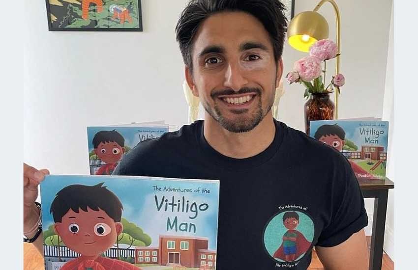 Author Shankar, who has vitiligo, holding his book, The Vitiligo Man