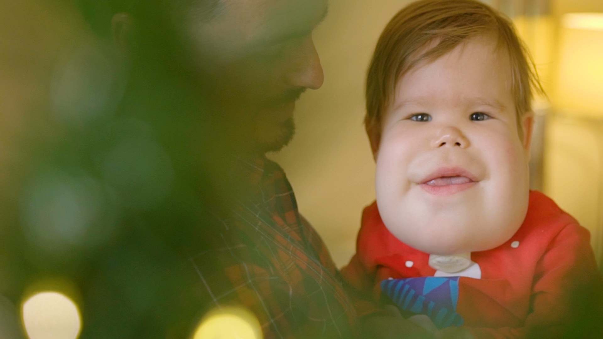 A two year-old boy with lymphangioma, which shows as swelling around the lower half of his face