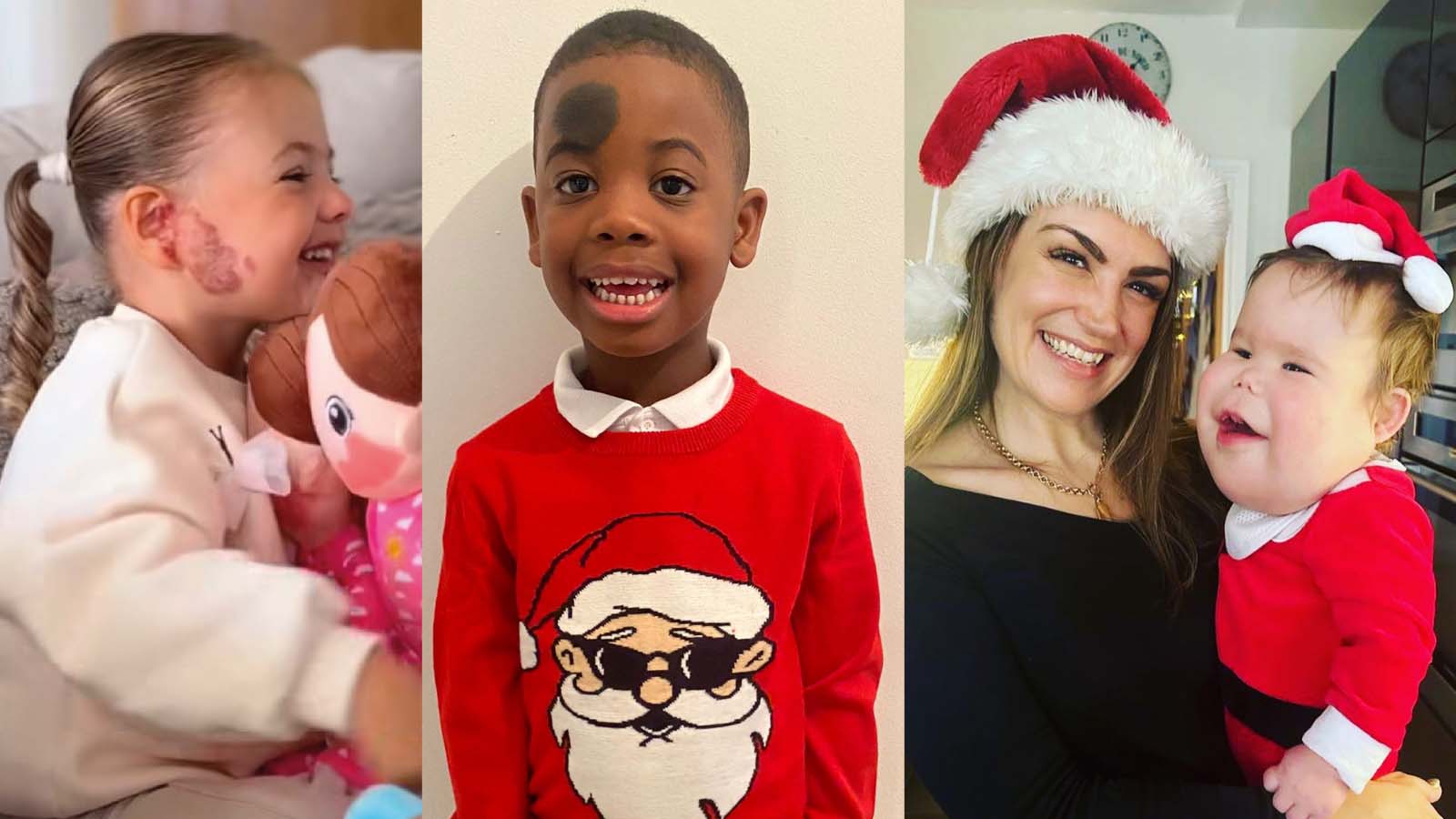 Three young children all with a facial visible difference