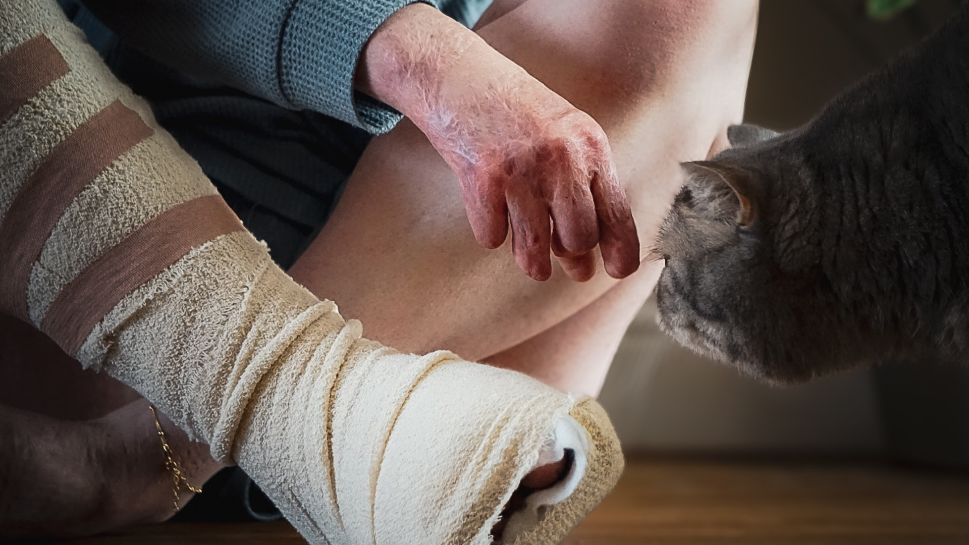 Image highlights Lucy's limb loss, foot in bandage, stroking her cat.