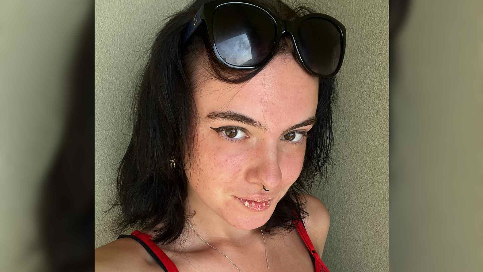 A selfie of Shae. She has sunglasses on top of her head. Shae found meeting other people with a visible difference helped her process her own skin condition which is on her lips.