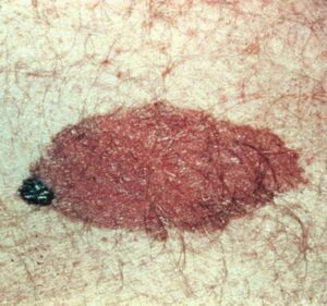 A medium congenital melanocytic naevus on a light-skinned adult 