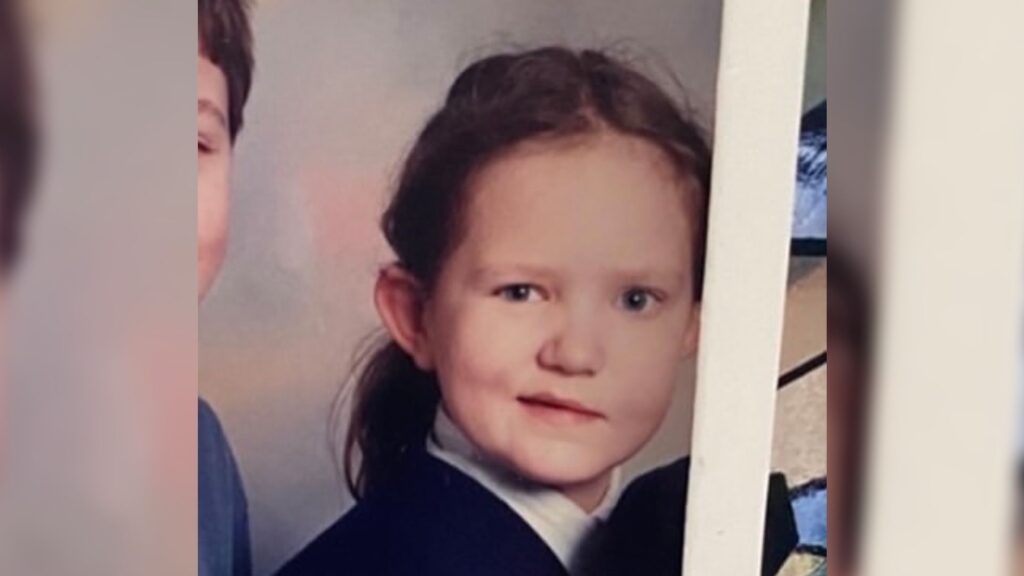 A photo of Beth as a young girl with facial palsy.