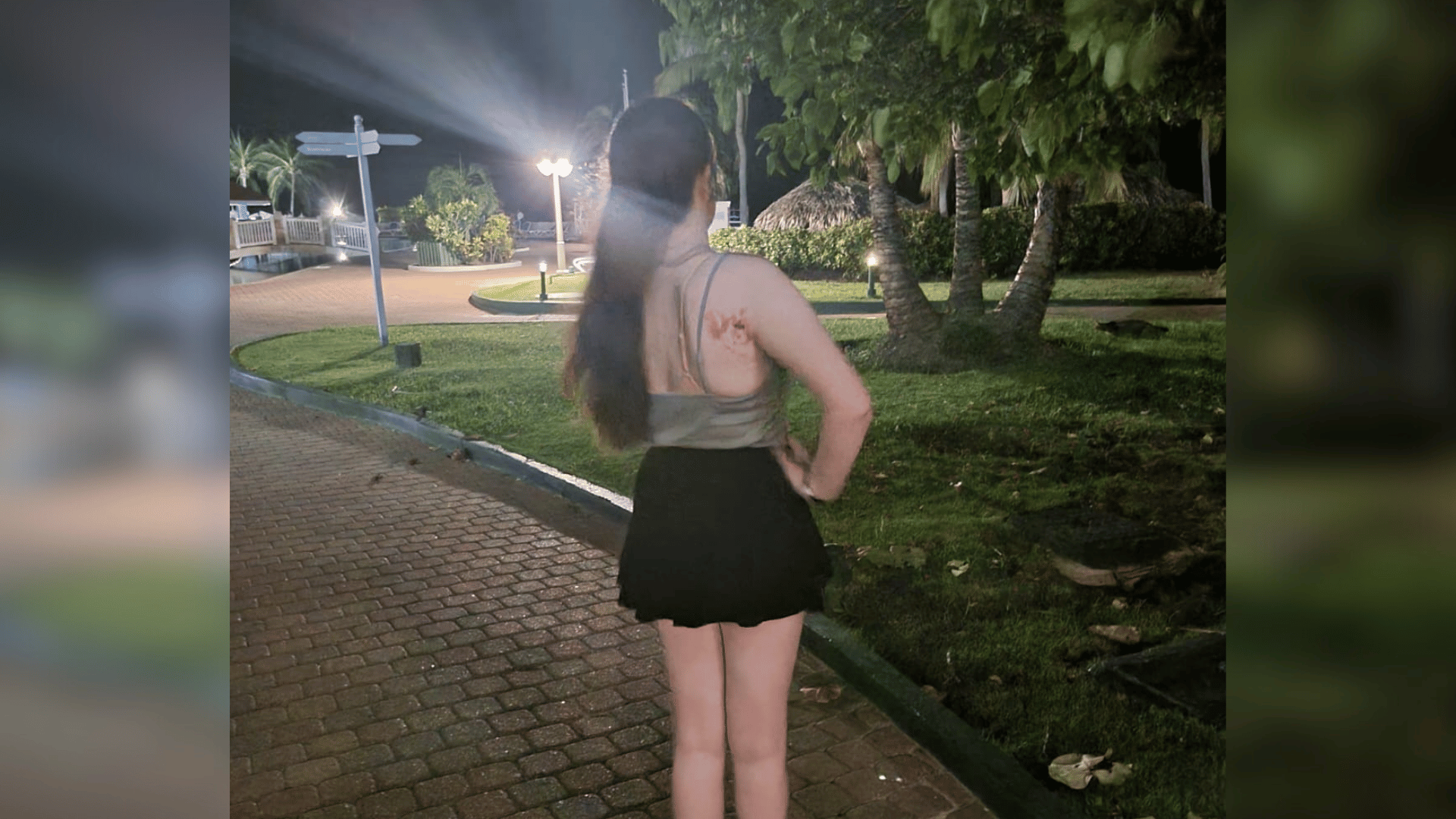 Cerys has a lymphatic malformation on the right side of her back. She faces away from the camera with her hand on her hip.