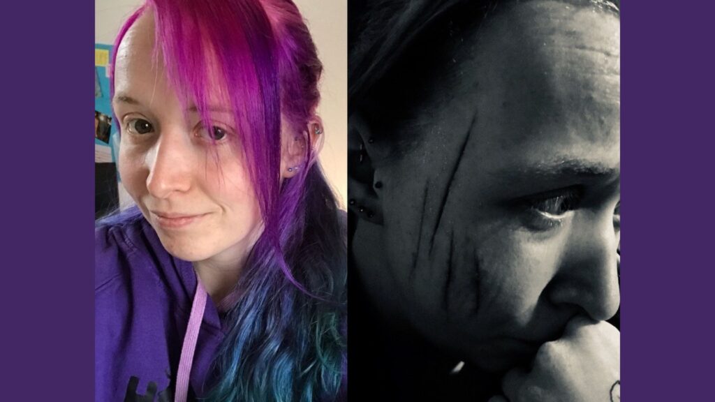 Two images of Ellie. One shows her smiling with bright pink and purple hair and the other is black and white with her facial scars visible. Selfie culture with a visible difference has been difficult for Ellie to navigate as she felt she could only show the bright version of herself.