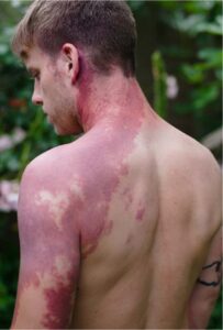 Dean showing a birthmark on his back and left arm