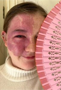 Evie looking at the camera with a birthmark on her face. She is holding a pink fan in her left hand.