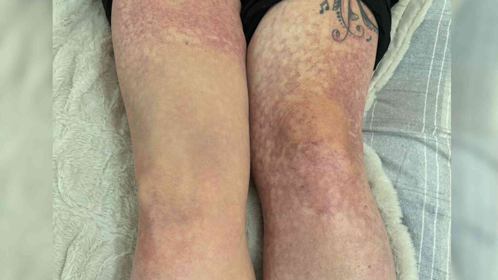 The imahe shows the telangiectasias on Jen's legs. On part of one leg, she has used Skin Camouflage makeup to cover the condition.