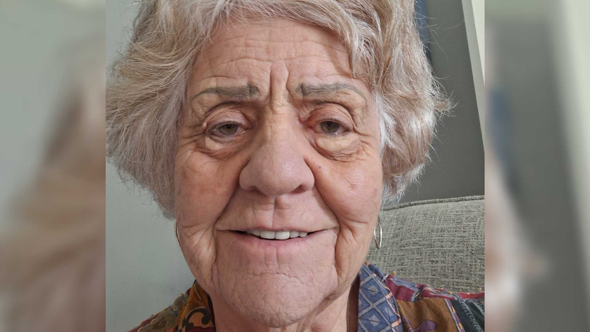 Lis is a 77 year old woman with skin grafts visible under her eyes. She has short grey hair and smiles at the camera.