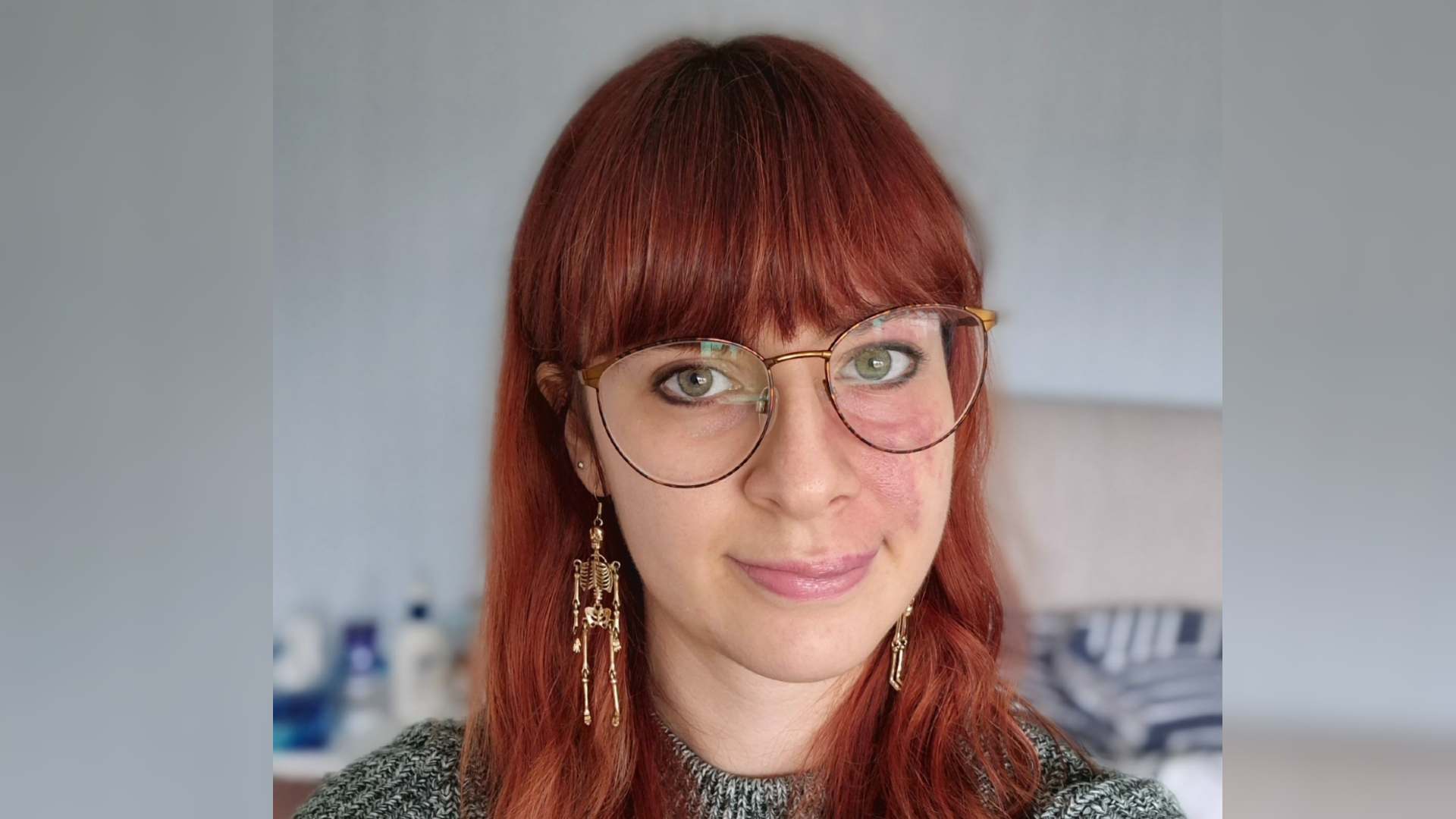Shelley is a white woman with reddish hair and a port wine stain birthmark on her cheek. She wears skeleton earrings to represent Halloween and visible difference.