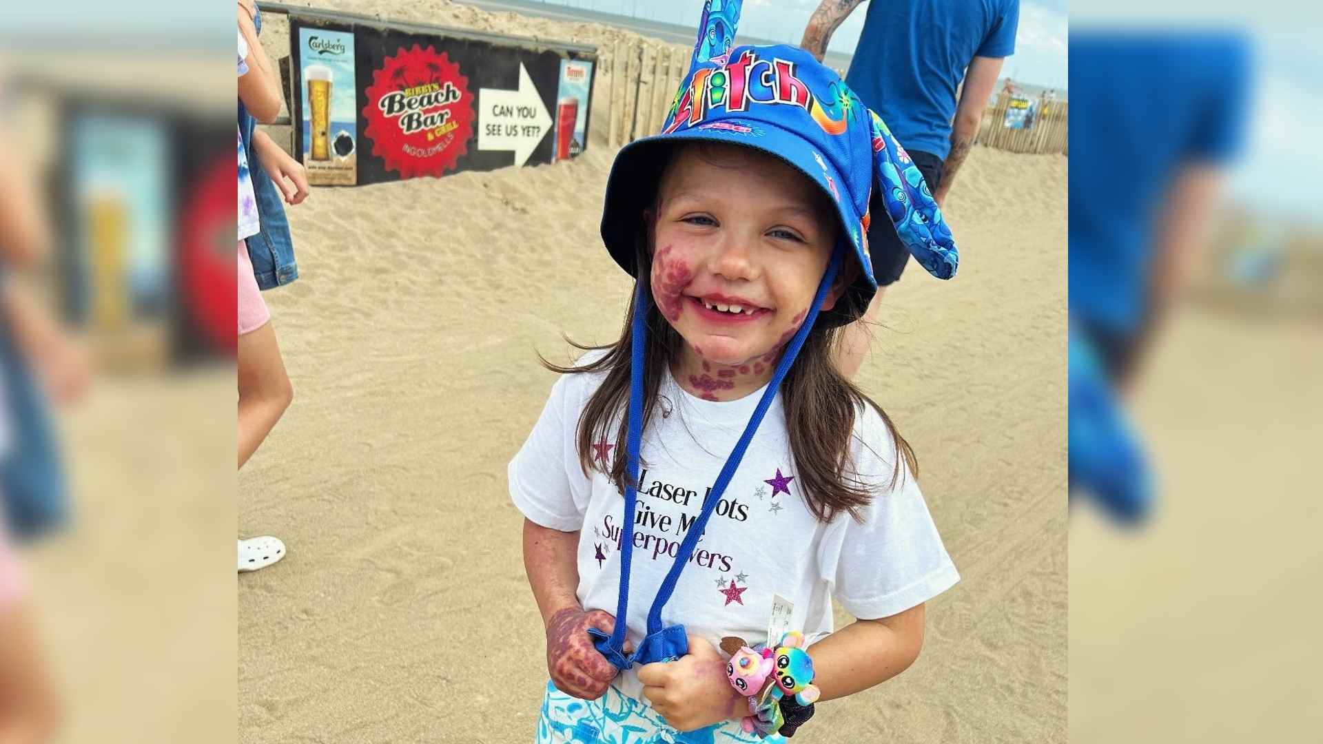 Lacey is a young girl with a port wine stain birthmark and Sturge-Weber syndrome. She stands on a beach smiling at the camera wearing a blue hat. Her t-shirt says "Laser dots give me superpowers".
