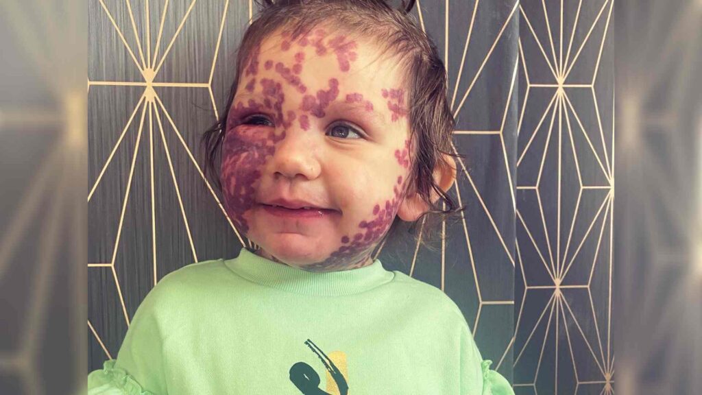 Lacey following laser treatment for her birthmark. She has dark red laser spots across her face.