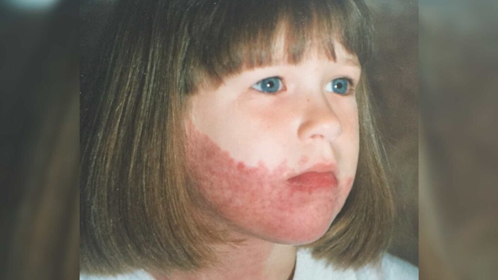 Sarah as a child. She has short light brown hair with a fringe. Sarah has a birthmark on her chin, jaw and lips.