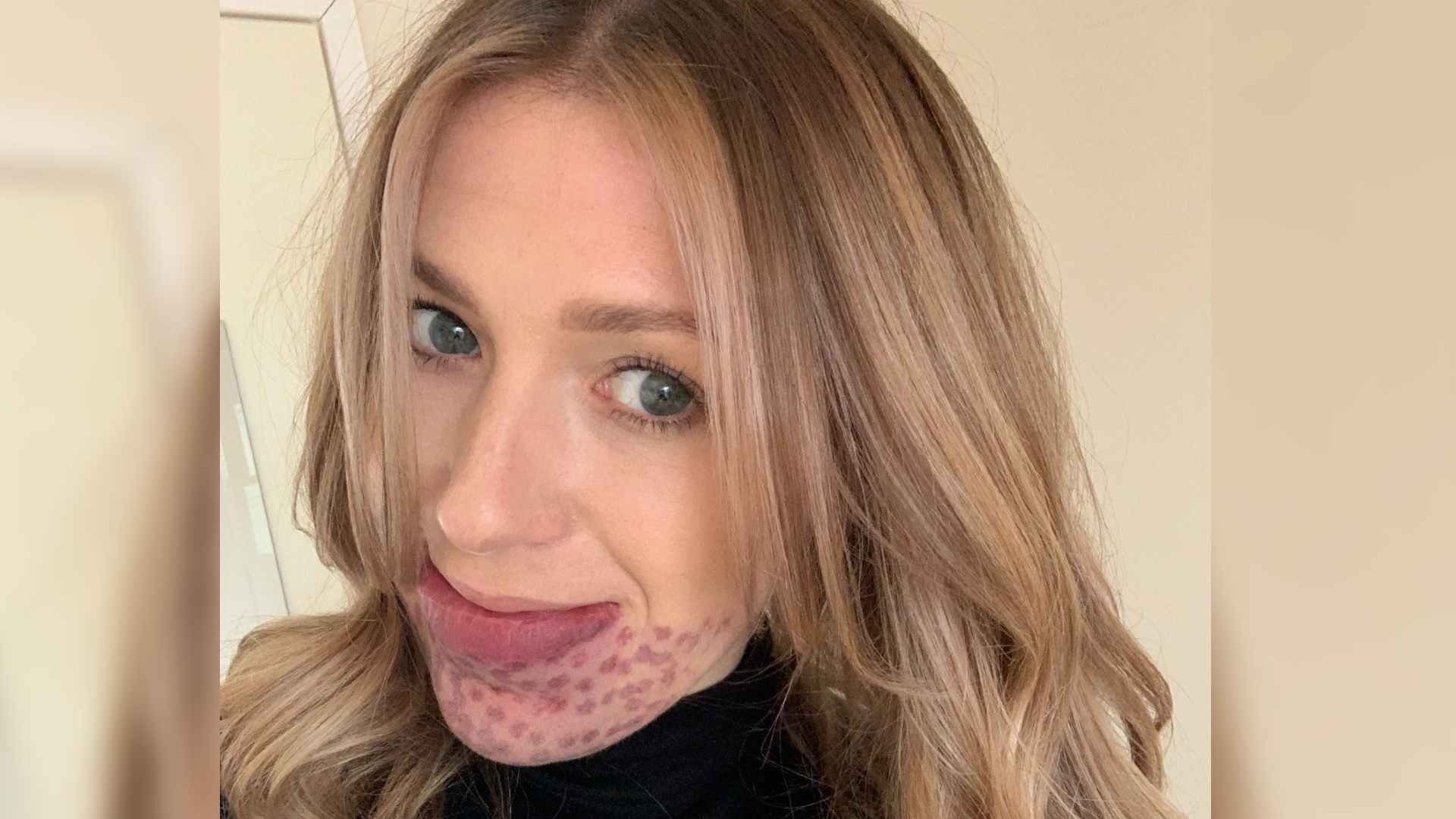 Sarah is a white woman with long blond hair. She has a birthmark on her lower lip and chin. Red dots can be seen from laser treatment.