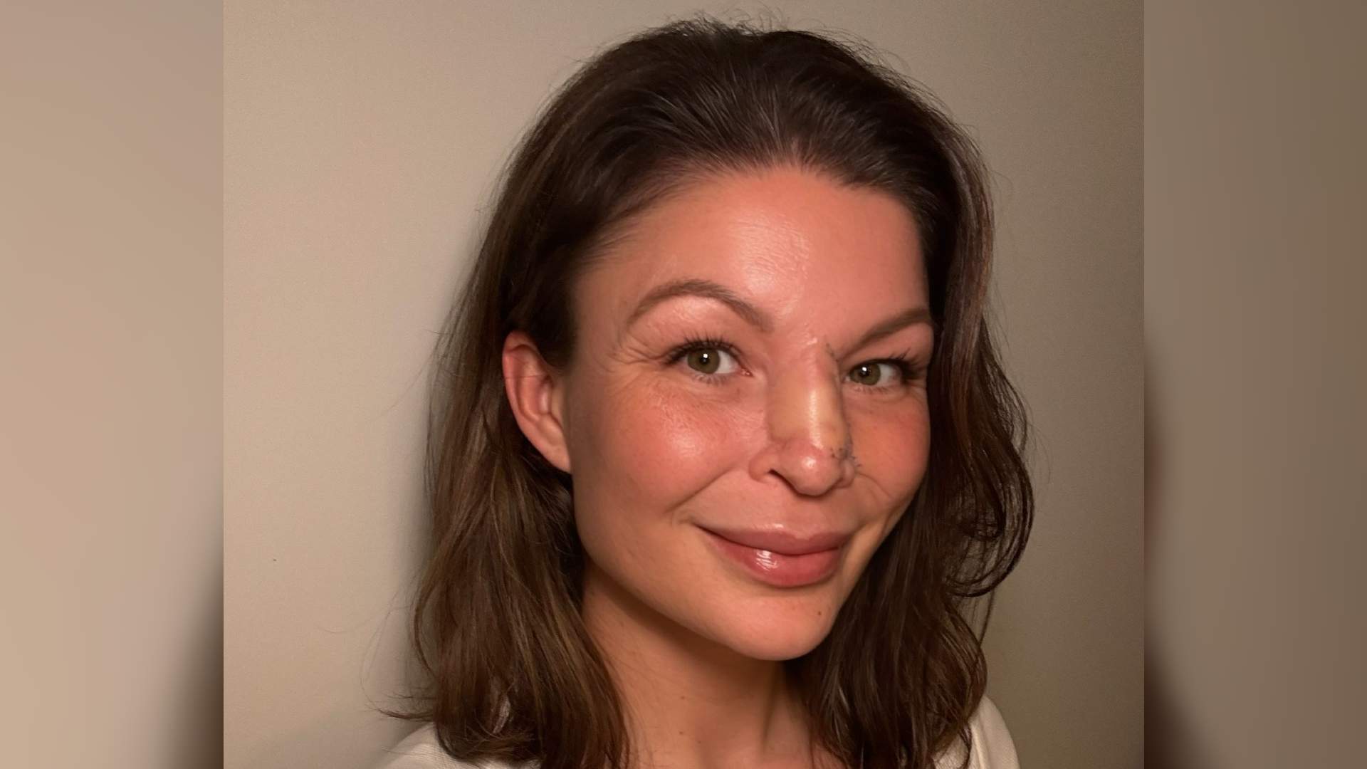 Vikki is a white woman with shoulder length brown hair. She has a facial difference after cancer, which led to her nose being removed and reconstructed.