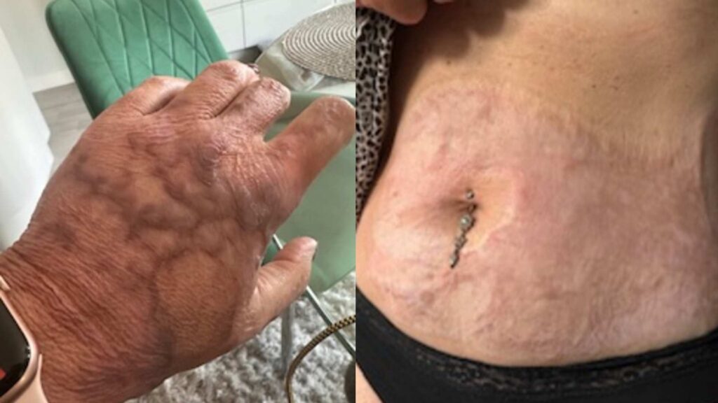 Two side by side images of Charlotte's burns scarring. The left image shows her hand, the right image shows her stomach.