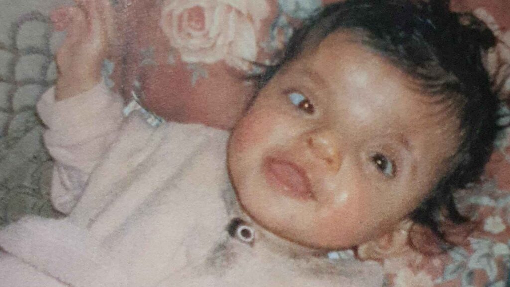 Sneha as a baby. She has craniofacial dysplasia.