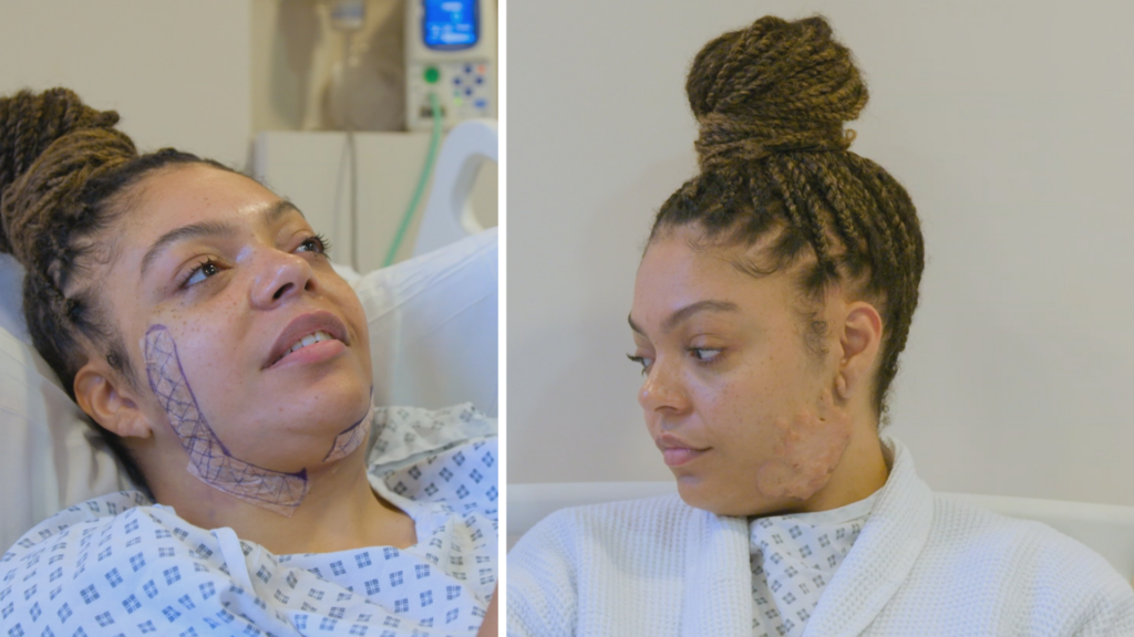 Bianca in hospital, after keloid scarring surgery