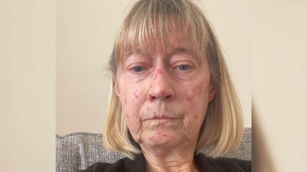 Janelle has Juvenile Dermatomyositis. A telangiectasia rash can be seen on her face.