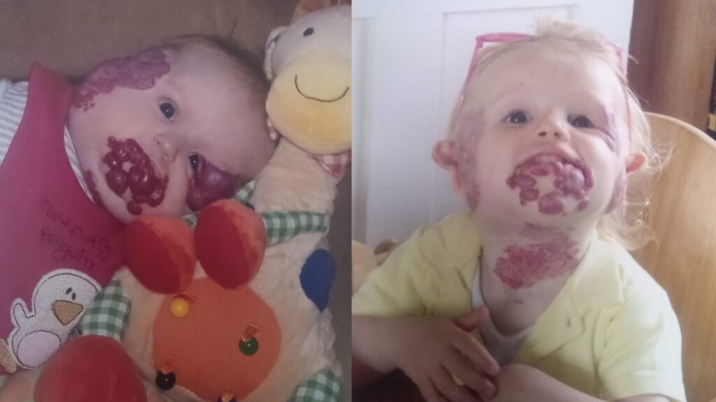 Two photos side by side of Rose as a baby and as a toddler. She has multiple haemangioma and naevus anaemicus birthmarks on her face and neck.
