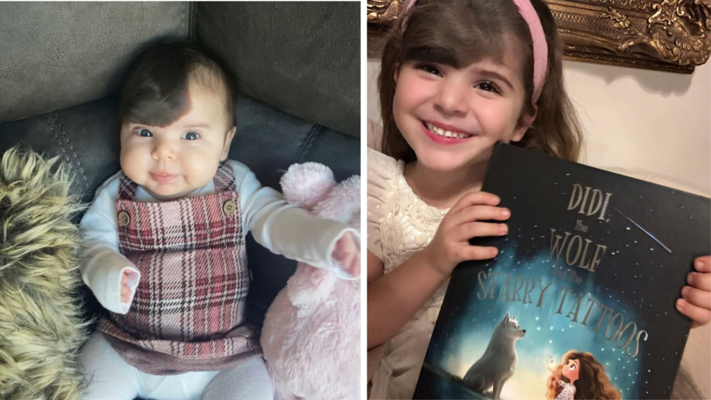 image of Alicia as a child and more recently, to highlight support with raising awareness for - Congenital Melanocytic Naevus