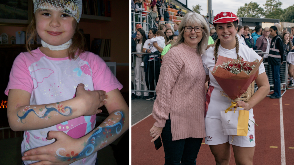 Sophie bridger, a professional rugby player with a CMN birthark - two photos, one as a child, one with her mum