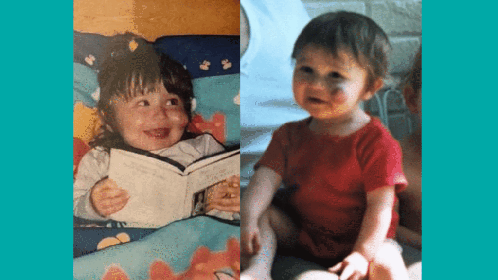 Two photos of Rachel from when she was a baby, before haemangioma removal. Her haemangioma can be seen on her cheek.
