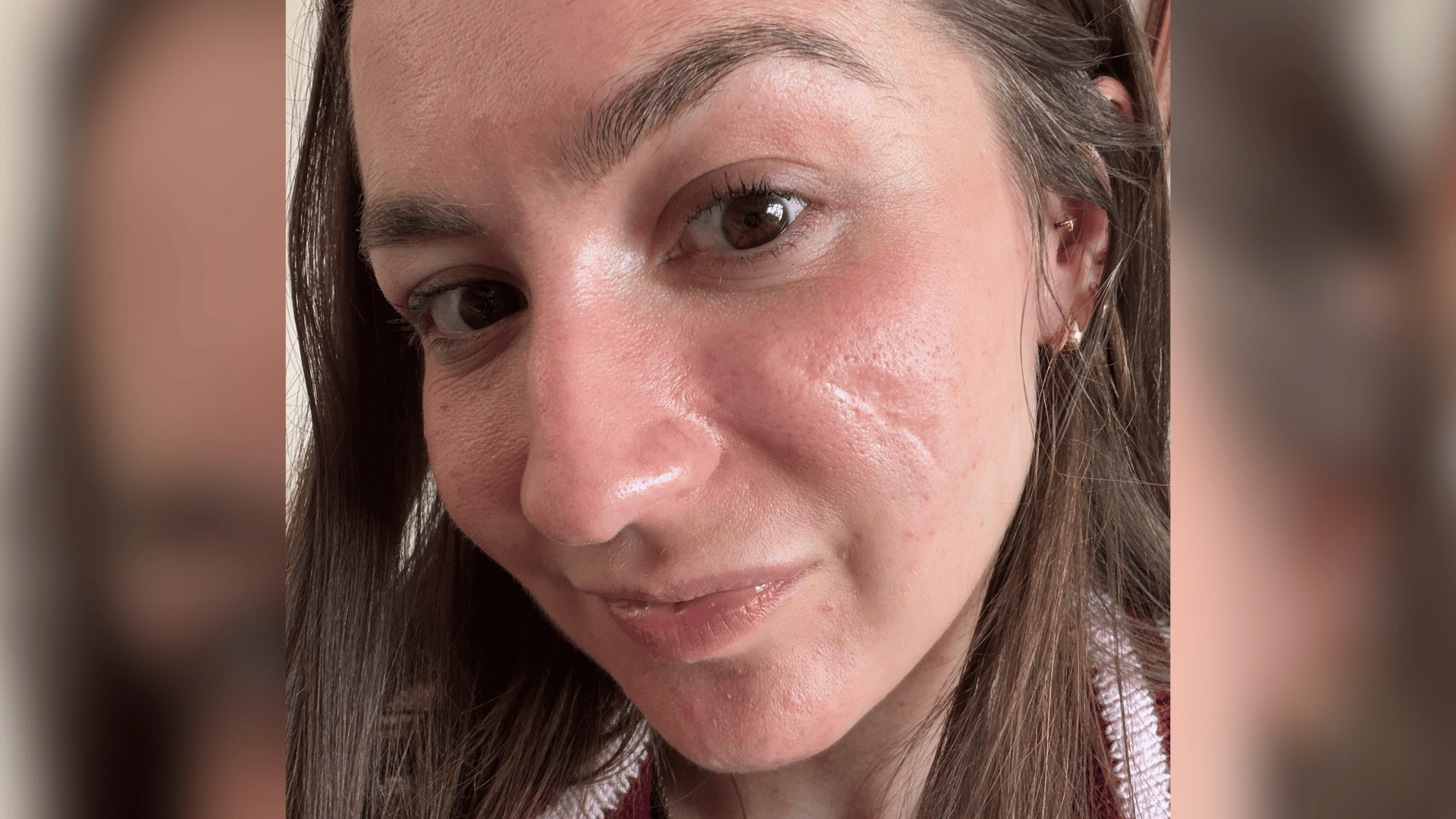 A selfie of Rachel. She has scarring on her cheek following haemangioma removal.
