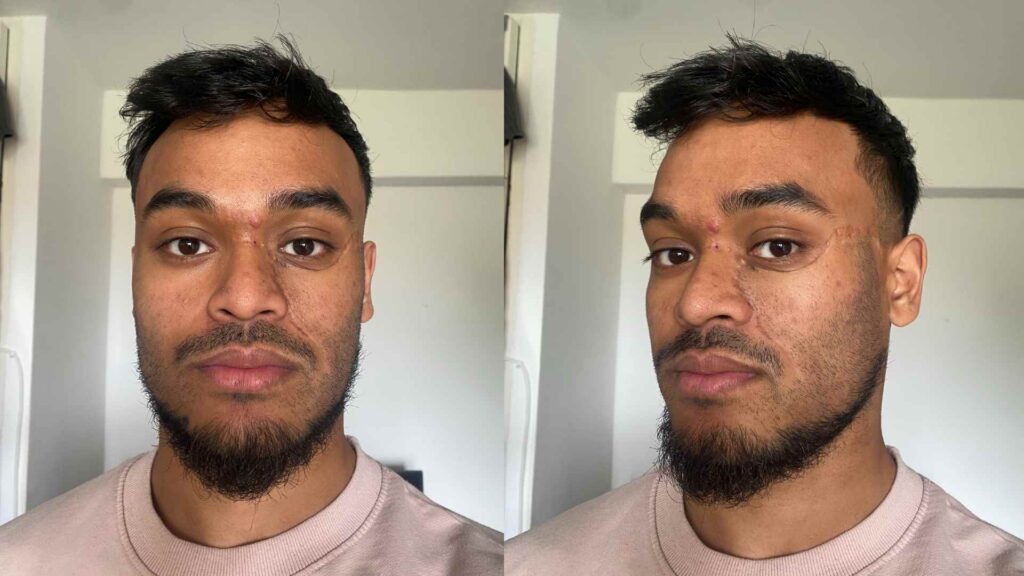 Two selfies of Yunus side by side. His facial scarring following the removal of a birthmark can be seen.
