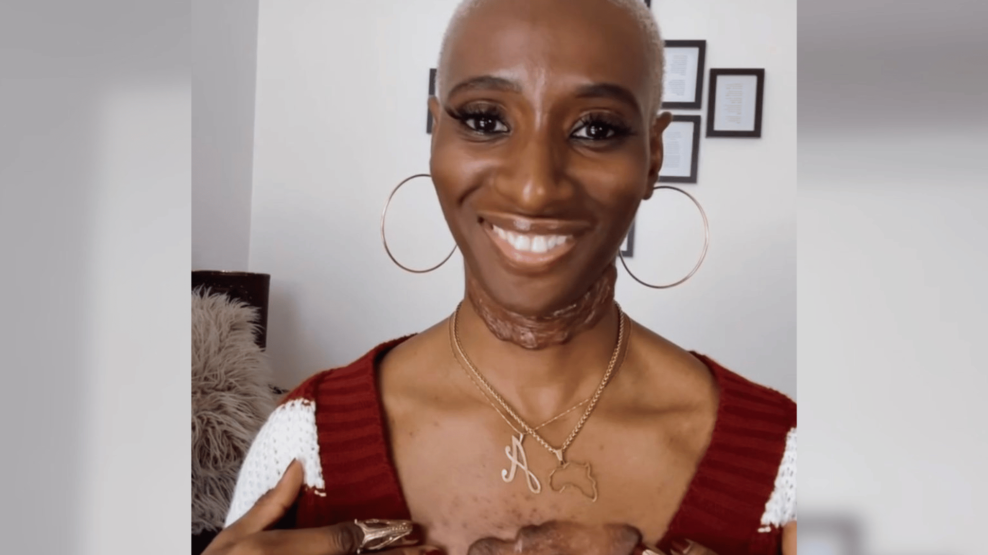 Ada smiles brightly at the camera. She has keloid scars on her neck and chest.