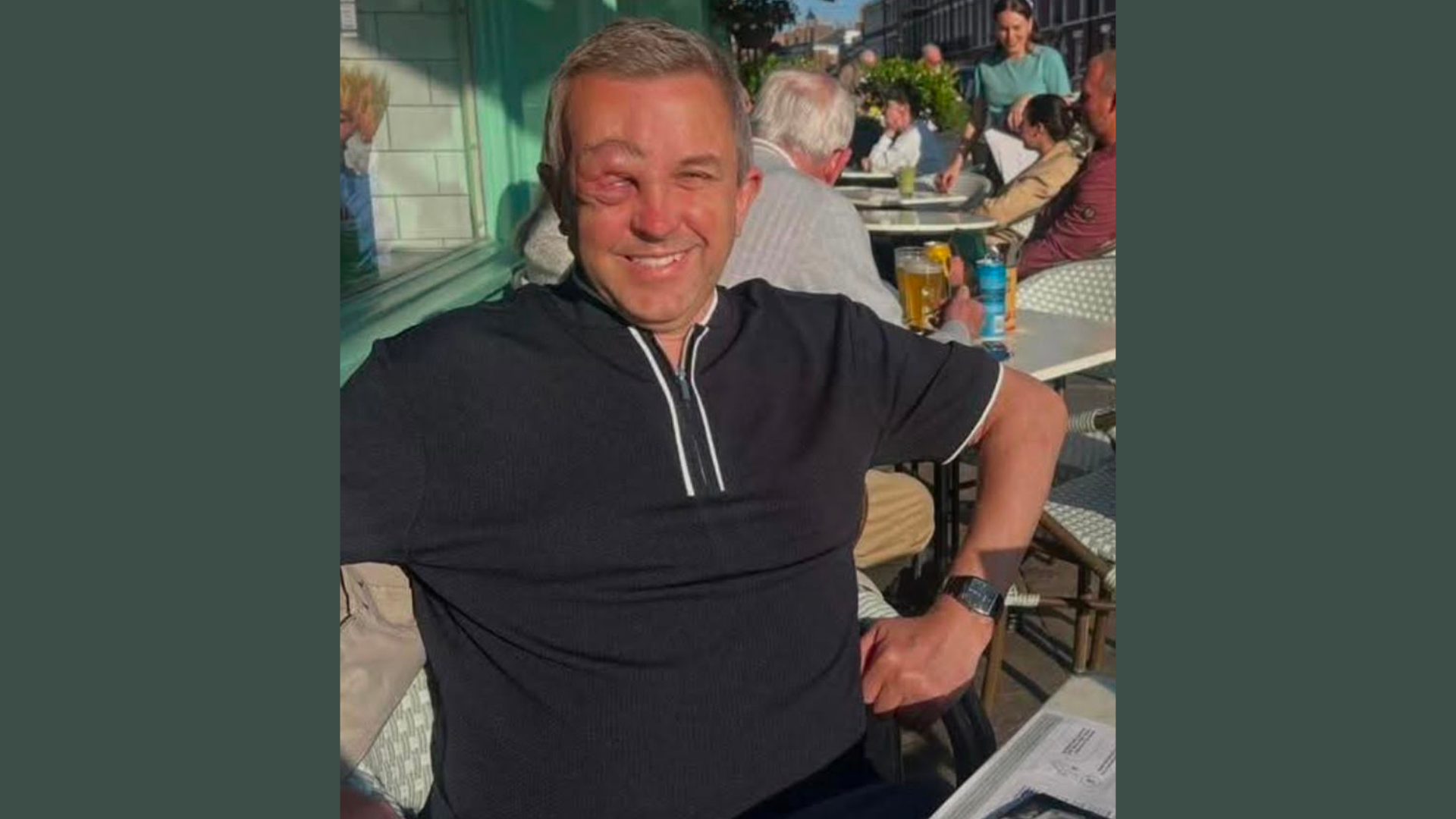 Phil, a white man in his fifties, living wtih condition NF1 which presents as a facial difference