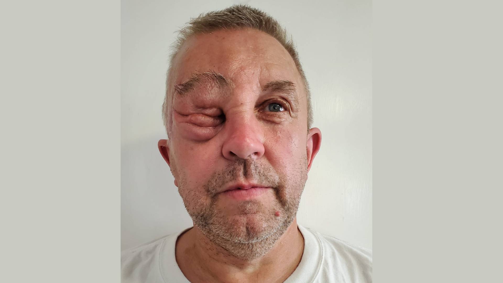 Phil, a white man in his fifties living with nf1